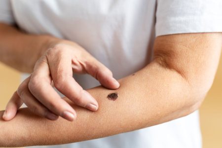 Dezembro Laranja: Dermatologista reforça importância da prevenção ao Câncer de Pele